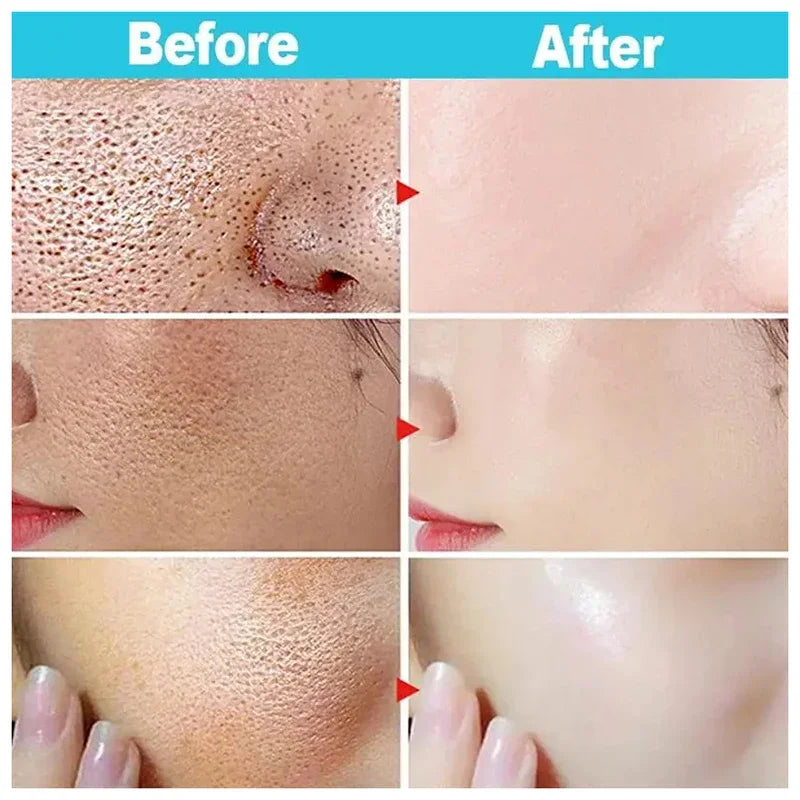 Pore Shrinking Cream Salicylic Acid Cream