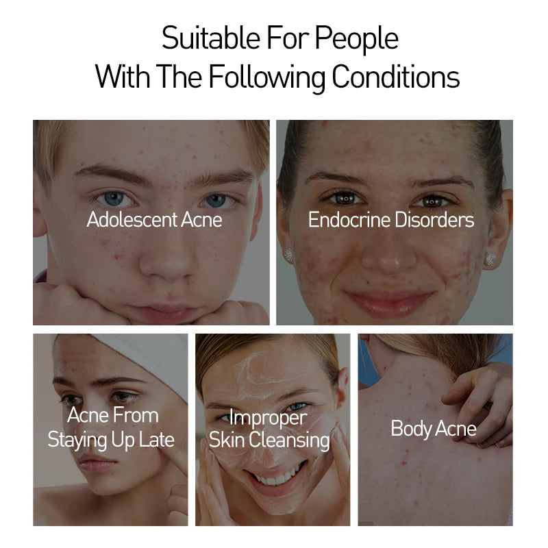 Acne Treatment Pimple Removal Oil Control Pore Shrinking Facial Cream