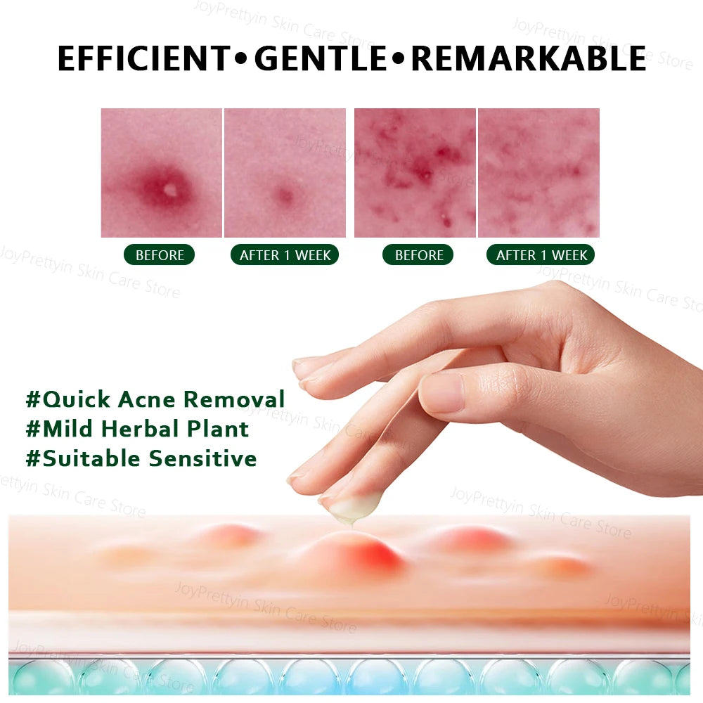 Herbal Acne Face Cream