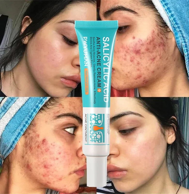 Salicylic Acid Acne Treatment Cream Repair Pimple Spots Serum