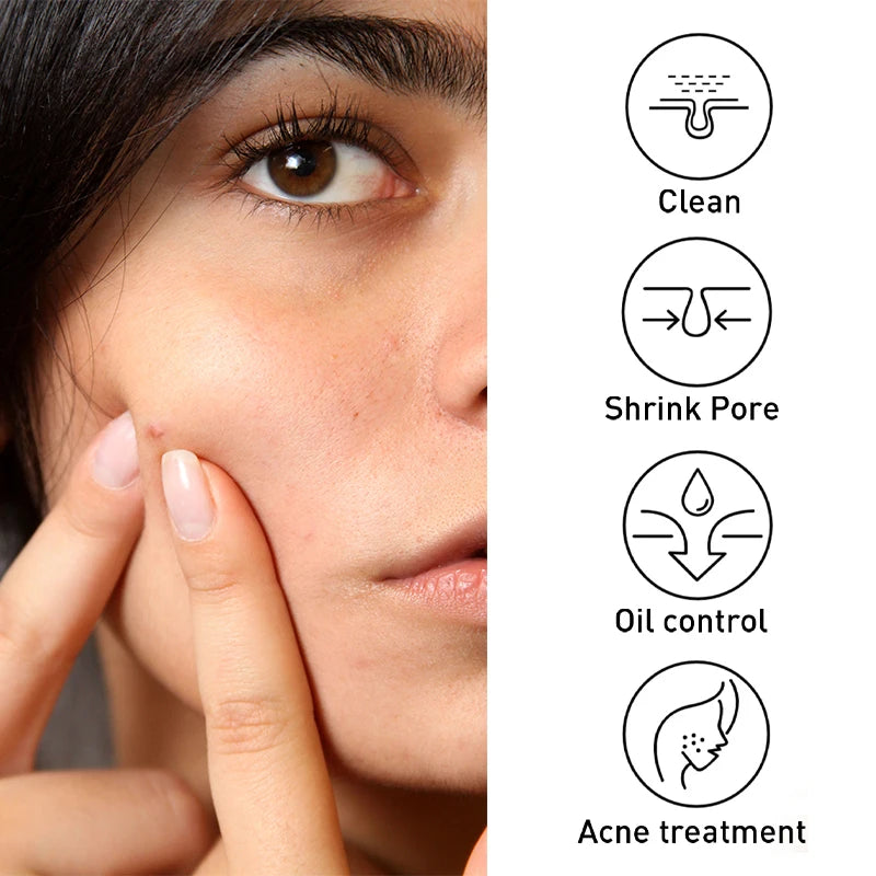 Acne Treatment Pimple Removal Oil Control Pore Shrinking Facial Cream