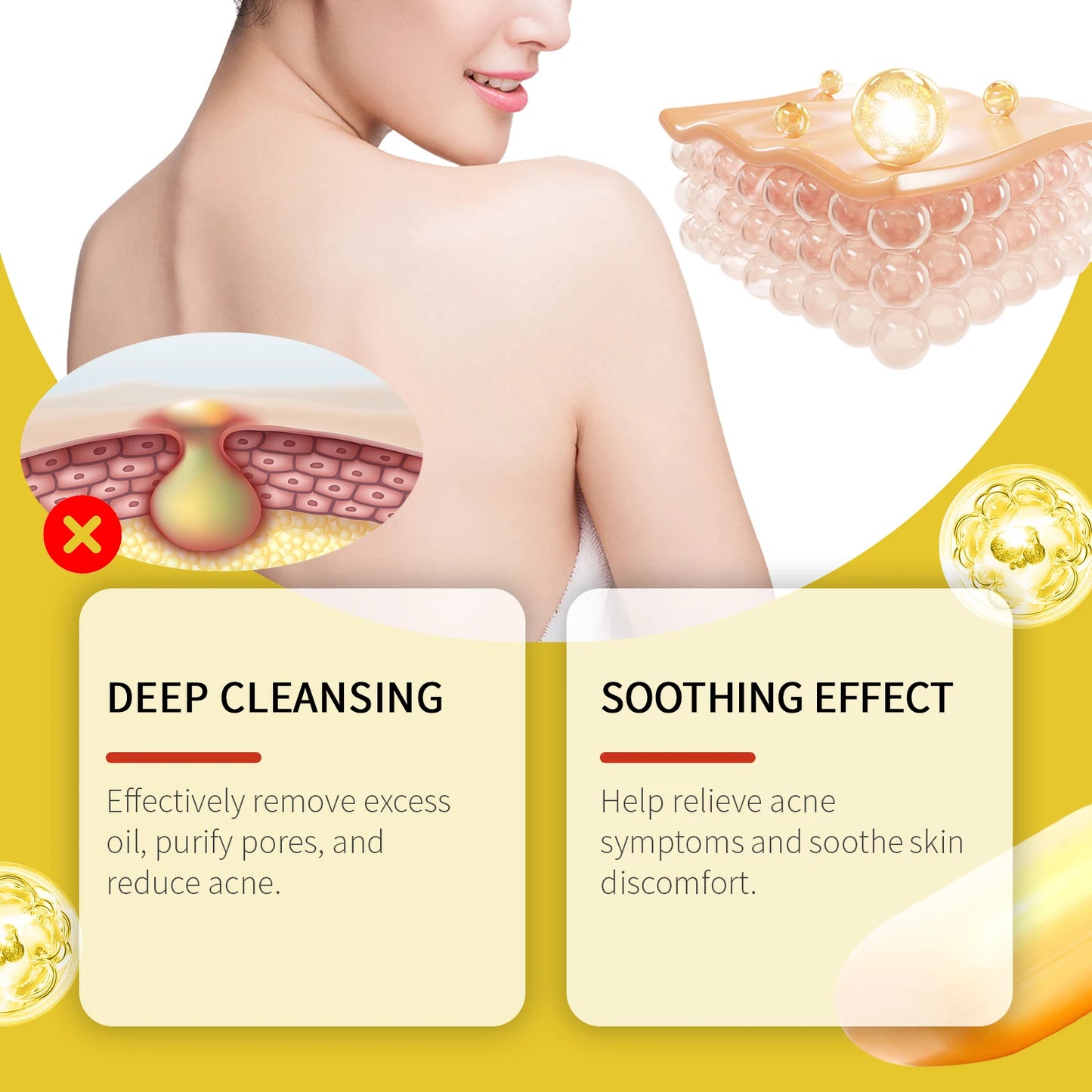 Acne Treatment Soap Deep Cleansing