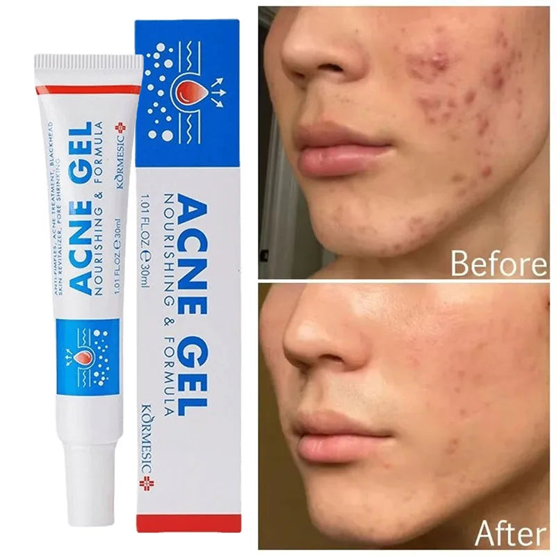 Effective Acne Removal Cream Anti-Acne Repair Redness Pimple Spots