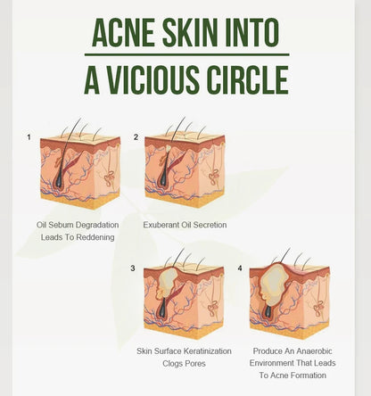 Acne Treatment Face Cream