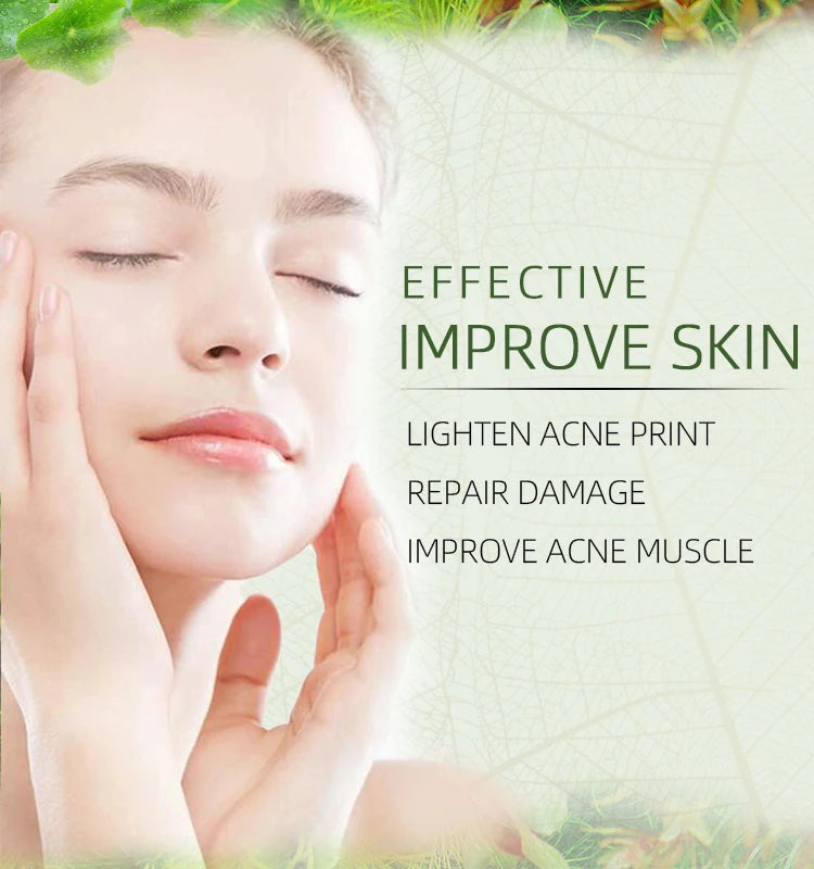 Herbal Acne Cream Oil Control