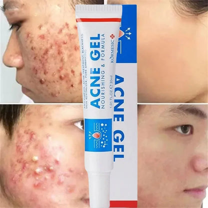 Effective Acne Removal Cream Anti-Acne Repair Redness Pimple Spots
