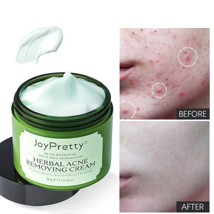 Herbal Acne Face Cream