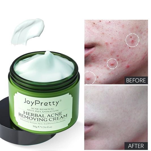 Herbal Acne Face Cream