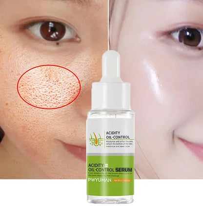 Salicylic Acid Acne Treatment Cream Repair Pimple Spots Serum