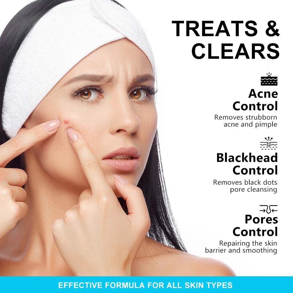 AUQUEST Salicylic Acid Acne Face Cream Pore Blackhead Removal