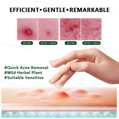 Herbal Acne Face Cream