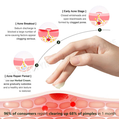 Herbal Acne Cream Oil Control