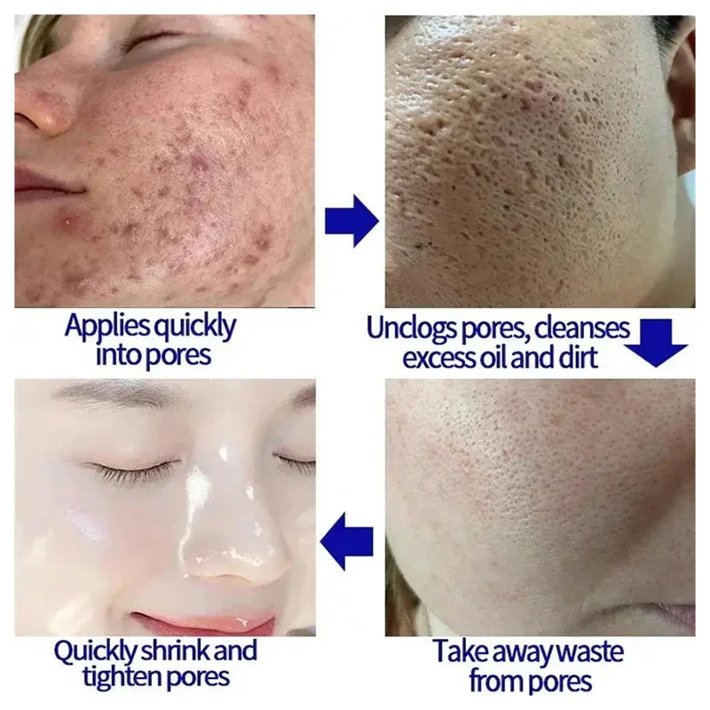 Pore Shrinking Cream Salicylic Acid Cream