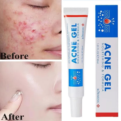 Effective Acne Removal Cream Anti-Acne Repair Redness Pimple Spots Gel Deep Cleaning Pore Oil Control Moisturizing Skin Care