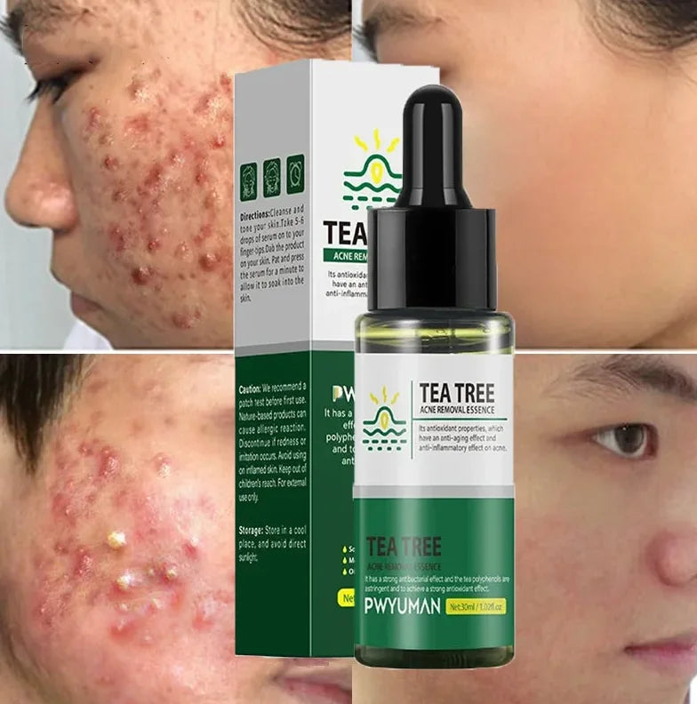 Salicylic Acid Acne Treatment Cream Repair Pimple Spots Serum