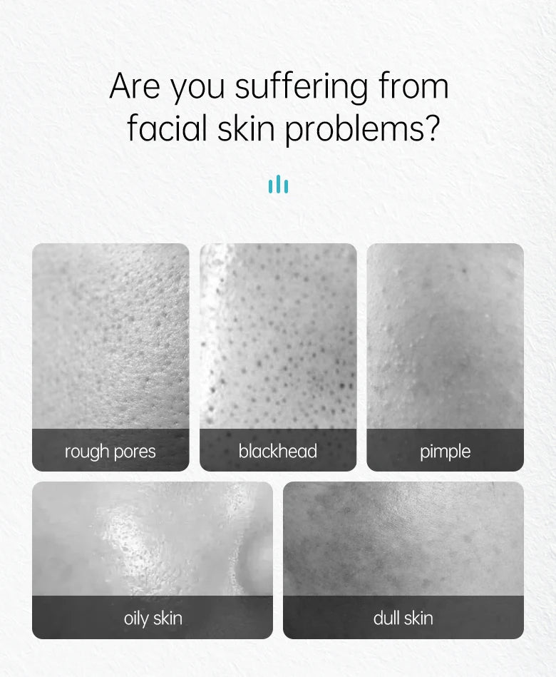 Acne Treatment Face Cream