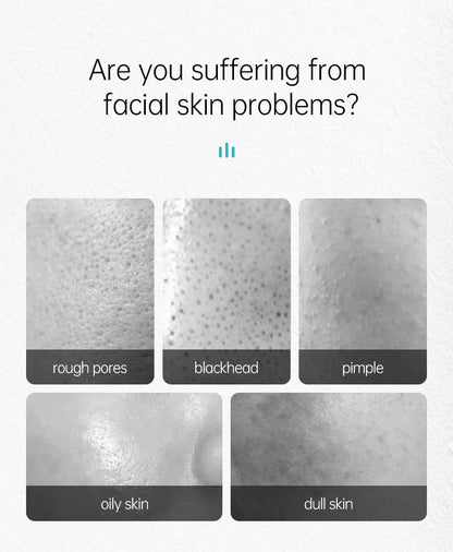 Acne Treatment Face Cream