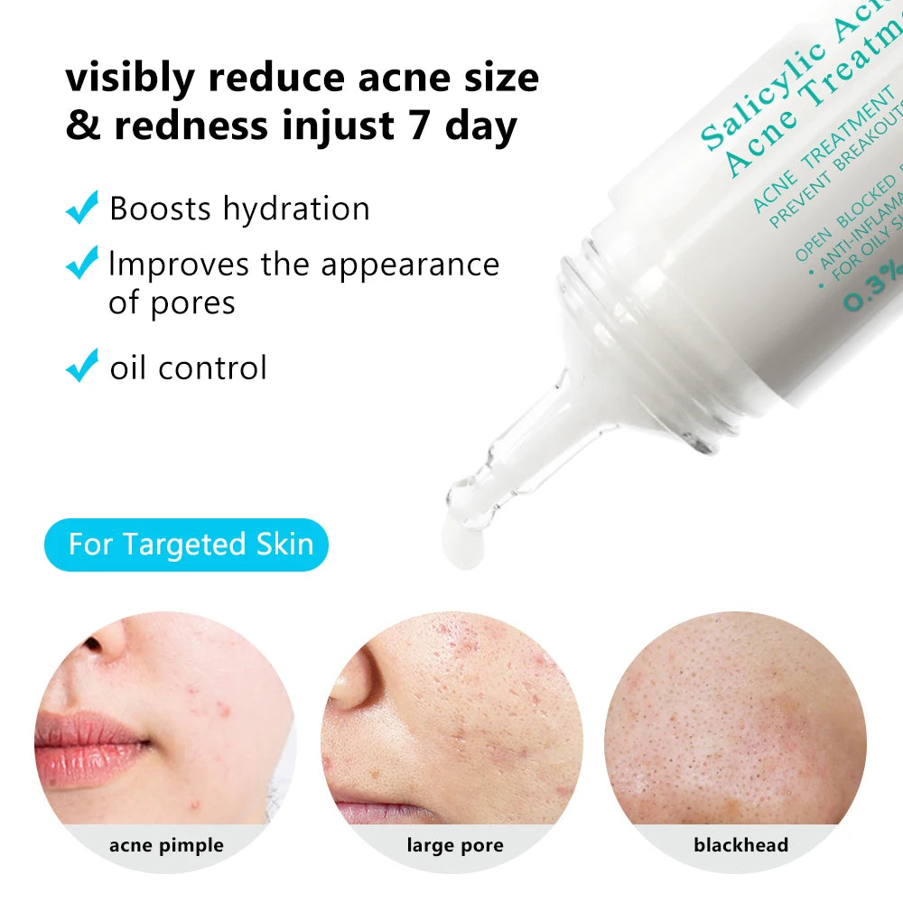 AUQUEST Salicylic Acid Acne Face Cream Pore Blackhead Removal