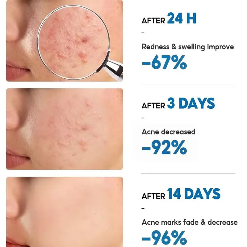 Effective Acne Removal Cream Anti-Acne Repair Redness Pimple Spots Gel Deep Cleaning Pore Oil Control Moisturizing Skin Care