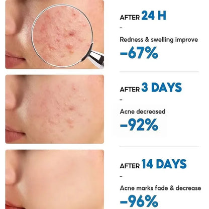 Effective Acne Removal Cream Anti-Acne Repair Redness Pimple Spots Gel Deep Cleaning Pore Oil Control Moisturizing Skin Care