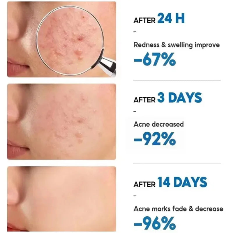 Effective Acne Removal Cream Anti-Acne Repair Redness Pimple Spots