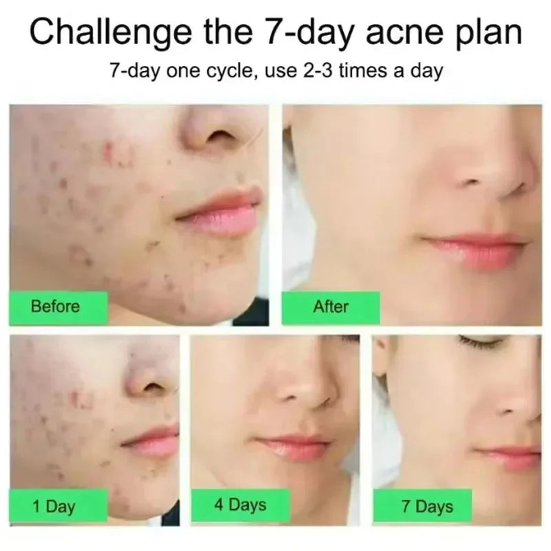 Effective Acne Removal Cream Anti-Acne Repair Redness Pimple Spots