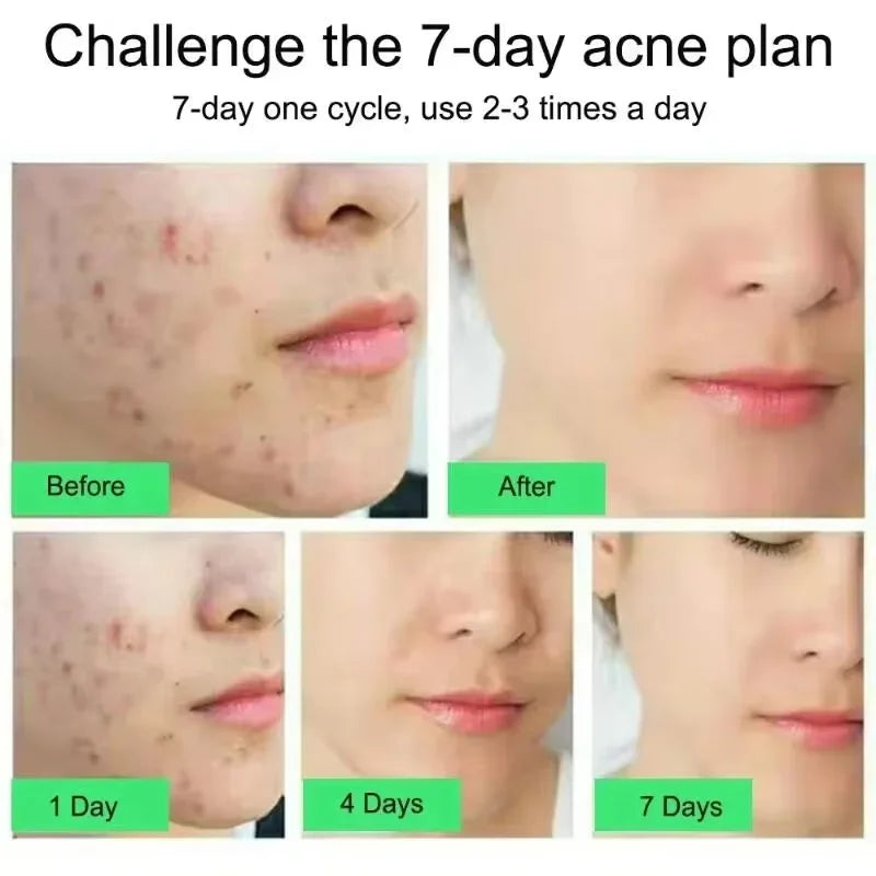 Effective Acne Removal Cream Anti-Acne Repair Redness Pimple Spots Gel Deep Cleaning Pore Oil Control Moisturizing Skin Care