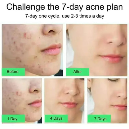 Effective Acne Removal Cream Anti-Acne Repair Redness Pimple Spots Gel Deep Cleaning Pore Oil Control Moisturizing Skin Care