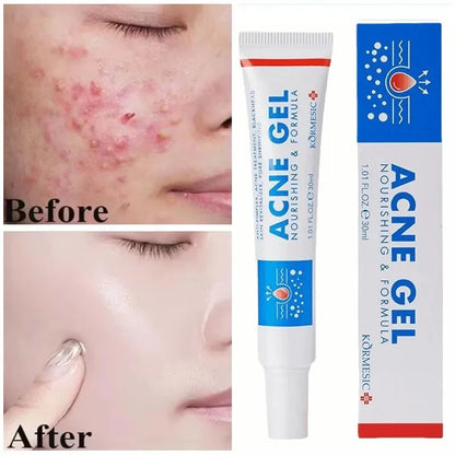 Effective Acne Removal Cream Anti-Acne Repair Redness Pimple Spots