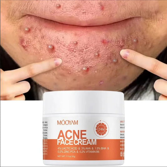Acne Treatment Cream Anti Acne Face Cream Pimple Removal Spots