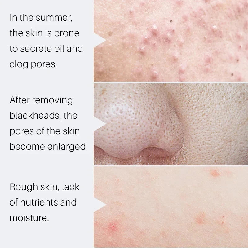 Pore Shrinking Cream Salicylic Acid Cream