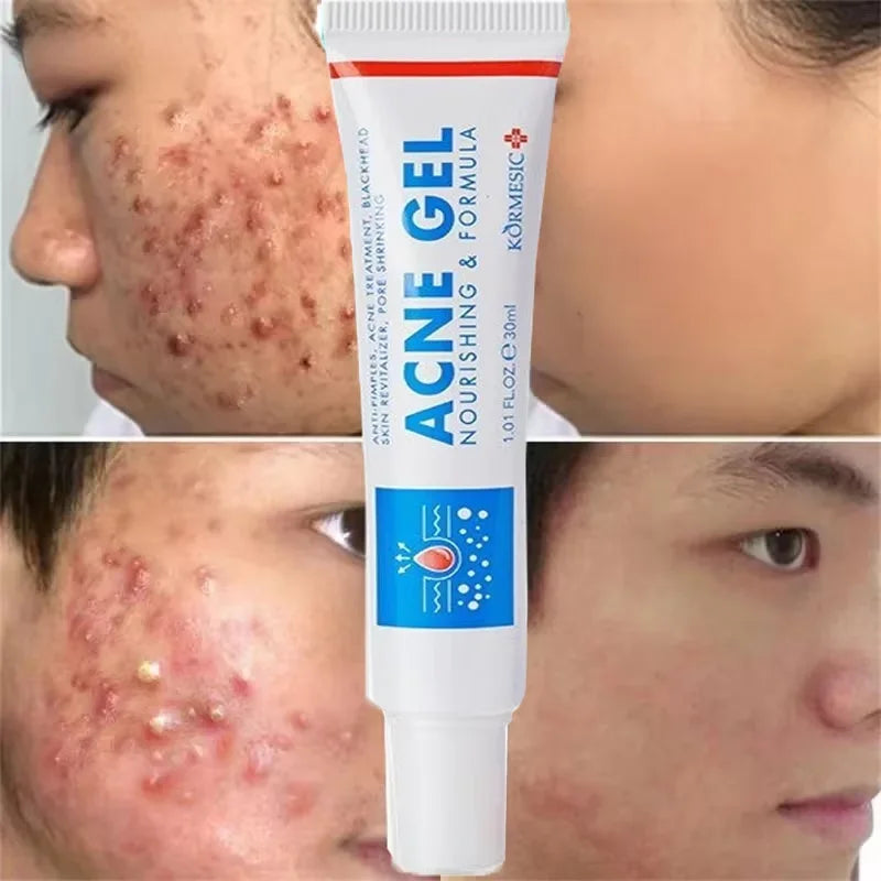 Effective Acne Removal Cream Anti-Acne Repair Redness Pimple Spots Gel Deep Cleaning Pore Oil Control Moisturizing Skin Care