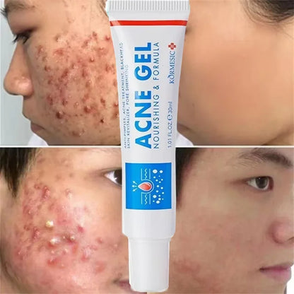 Effective Acne Removal Cream Anti-Acne Repair Redness Pimple Spots Gel Deep Cleaning Pore Oil Control Moisturizing Skin Care