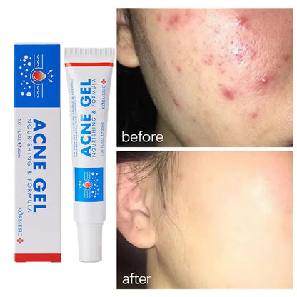 Effective Acne Removal Cream Anti-Acne Repair Redness Pimple Spots Gel Deep Cleaning Pore Oil Control Moisturizing Skin Care