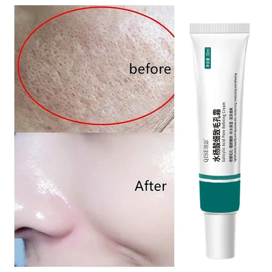 Pore Shrinking Cream Salicylic Acid Cream