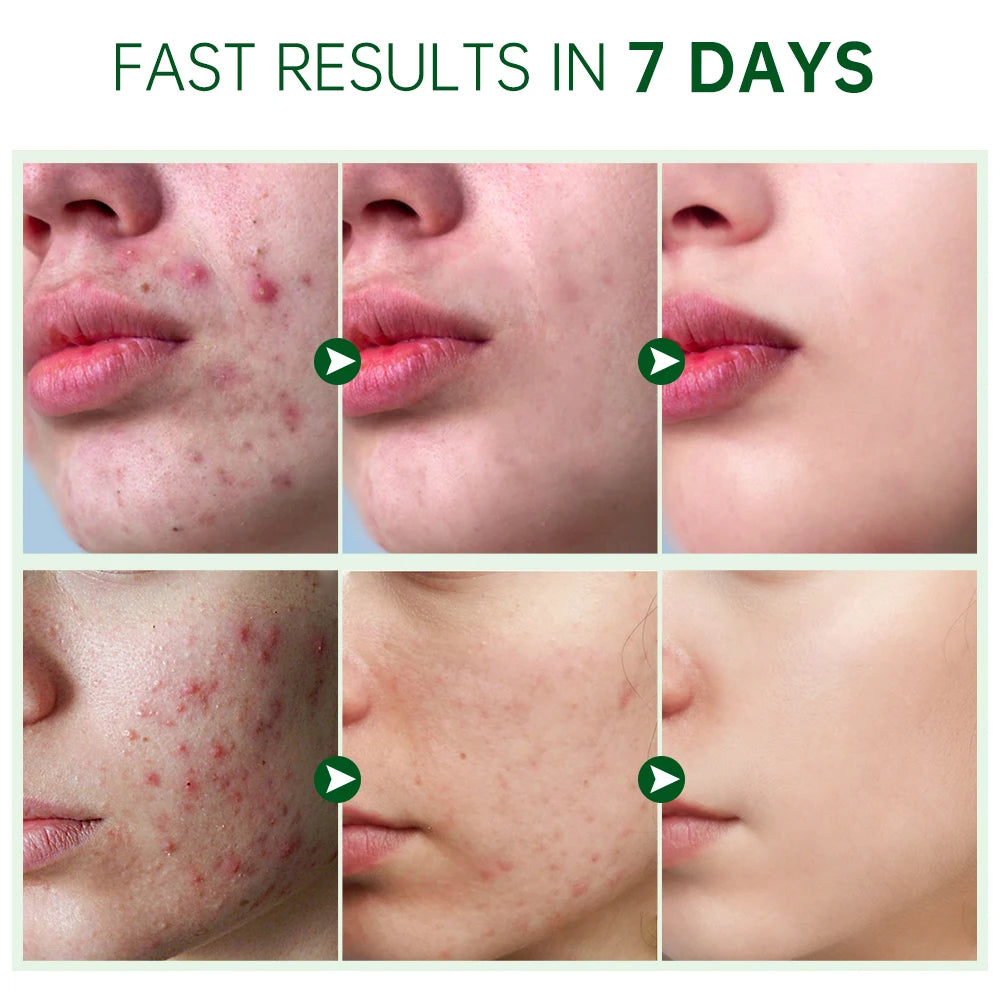 Herbal Acne Face Cream