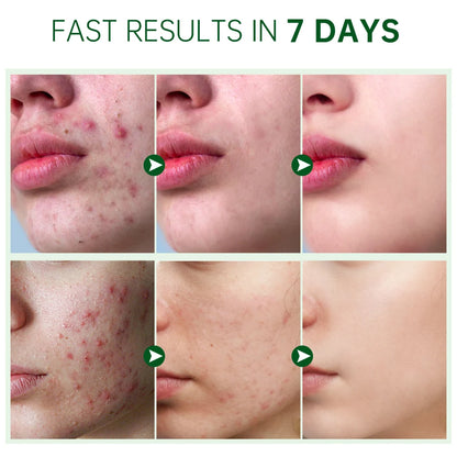 Herbal Acne Face Cream
