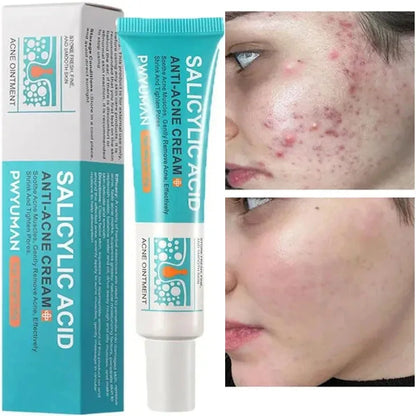 Effective Acne Removal Cream Anti-Acne Repair Redness Pimple Spots Gel Deep Cleaning Pore Oil Control Moisturizing Skin Care